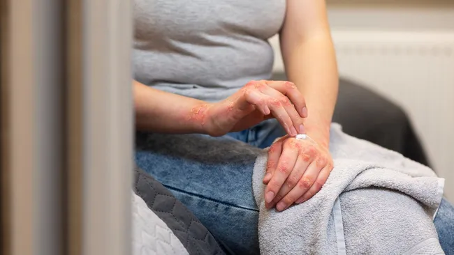 Растительный белок связали с более лёгким течением псориаза 