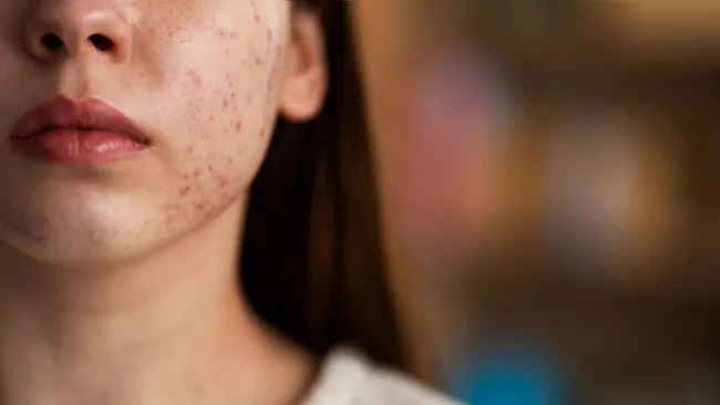 Нутрициолог Стародубцева: белая мука и сахар ухудшают состояние кожи 