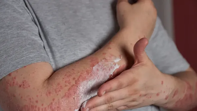 Дерматолог Русак: охватившим Европу Trichophyton indotineae можно заразиться в бассейне