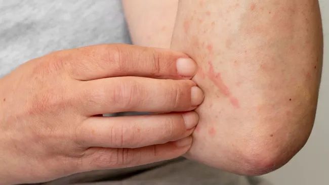  Врач подтвердила, что можно повторно заболеть ветрянкой 