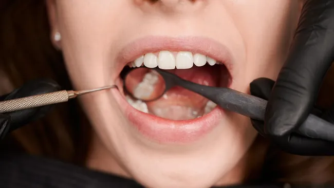 Учёные смогли победить кариес 