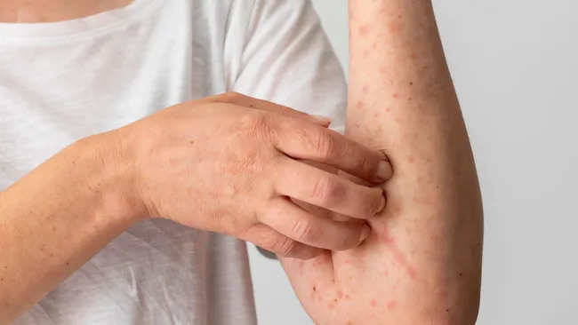 В ВОЗ предупредили о росте случаев кори во всем мире