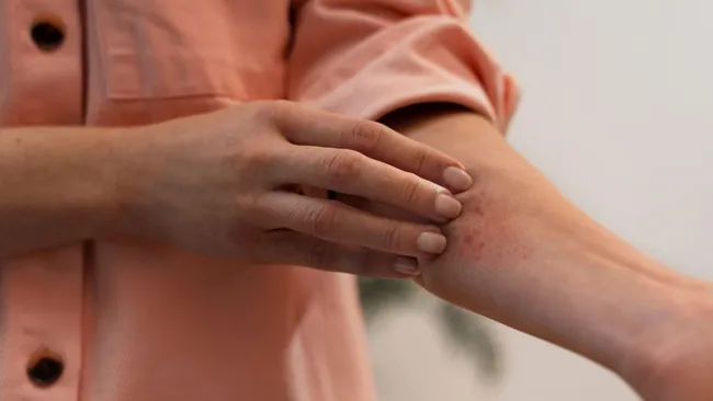 Атопический дерматит оказался связан со снижением когнитивных функций 