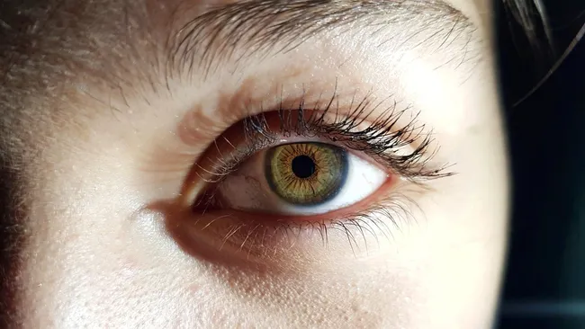 Стволовые клетки частично вернули зрение при возрастной макулярной дегенерации