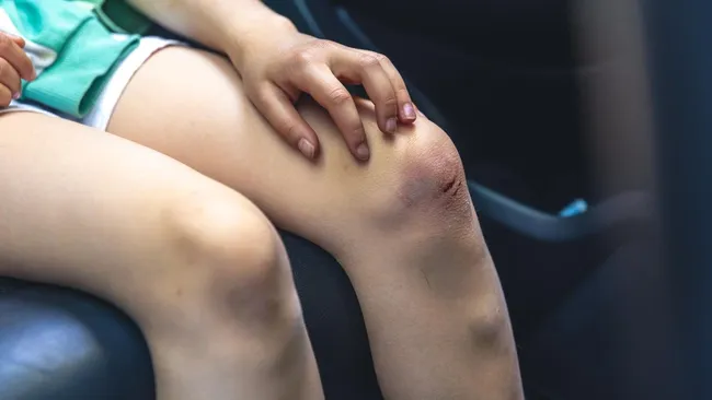 Эндокринолог Пришвина: незаживающие синяки могут быть признаком диабета