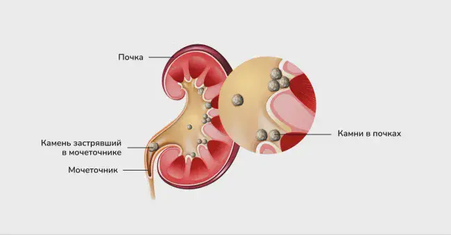 Камни в почках © Изображение: freepik.com