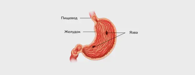 Язва желудка © Изображение: freepik.com