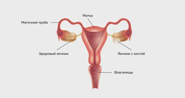 Киста яичника © Изображение: freepik.com